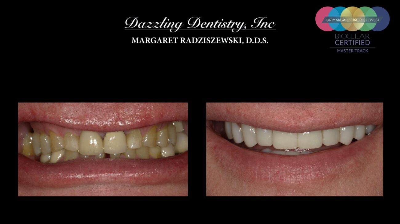 Dental patient before and after Bioclear in Chicago