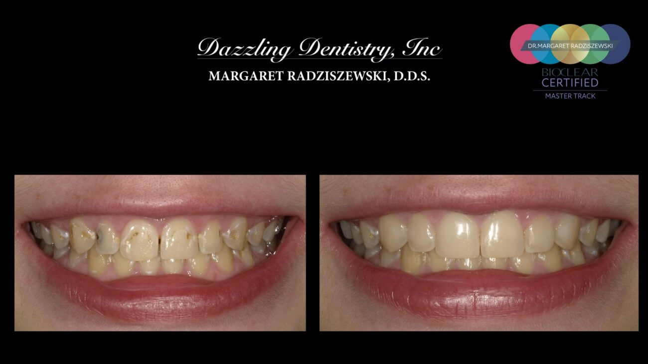 The Veneer Consultation: What a Dawson-Trained Dentist Looks For Before Recommending Treatment