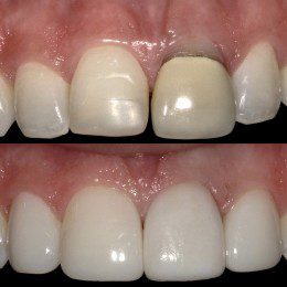 Before and after dental crown replacement at Dazzling Dentistry