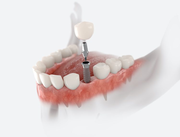 The process of receiving dental implants is not as simple as scheduling a single appointment. Some pretreatment may be needed.
