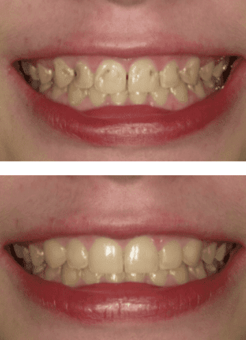 Before and After Dental Bonding
