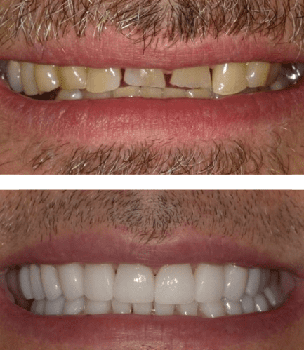 Before and After Veneers