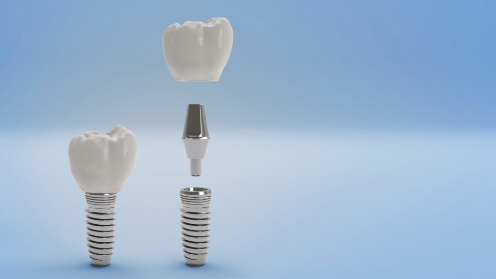 Parts of a Dental Implant Chicago IL