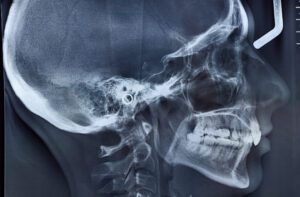 TMJ Therapy Arlington Heights IL