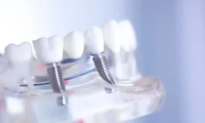Dental Implants vs. Dentures in Chicago, IL